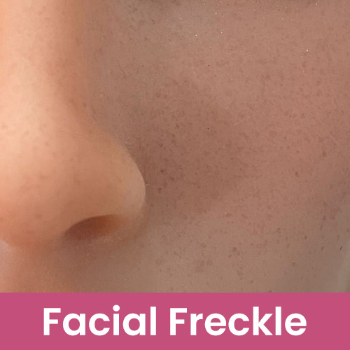 Sommersprossen im Gesicht [+€49]