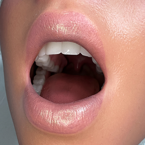 Andere Silikonköpfe mit ROS